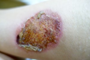 gruesome burn:(