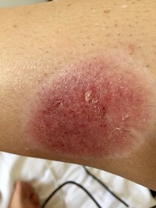 29 days later, healed!